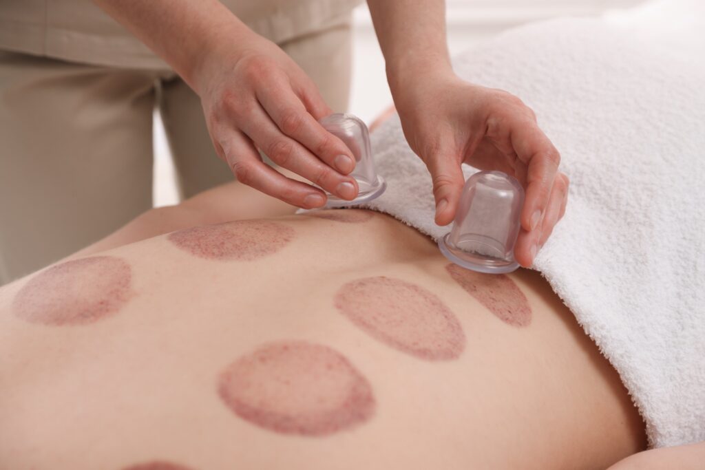 therapist-giving-cupping-therapy-to-patient