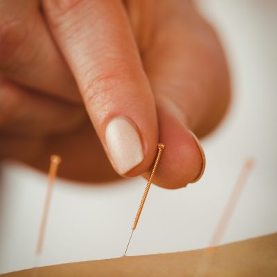 Young woman getting acupuncture treatment in therapy room